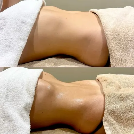Resultado antes y después de maderoterapia
