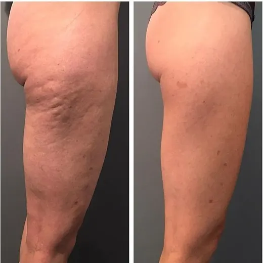 Resultado antes y después de maderoterapia