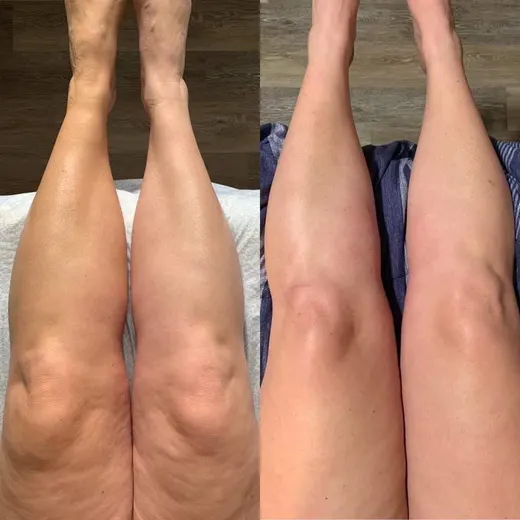 Resultado antes y después de maderoterapia