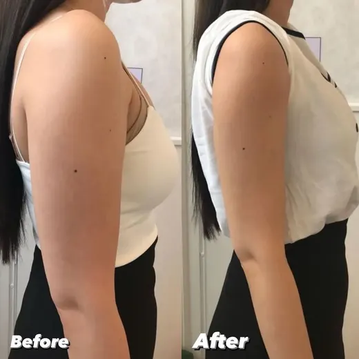 Resultado antes y después de maderoterapia