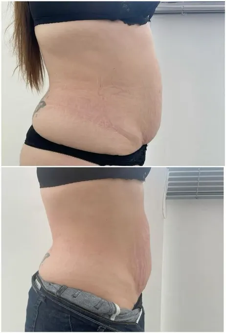 Resultado antes y después de maderoterapia
